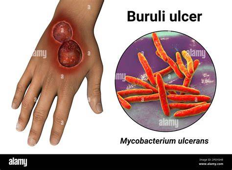 Buruli Ulcer3