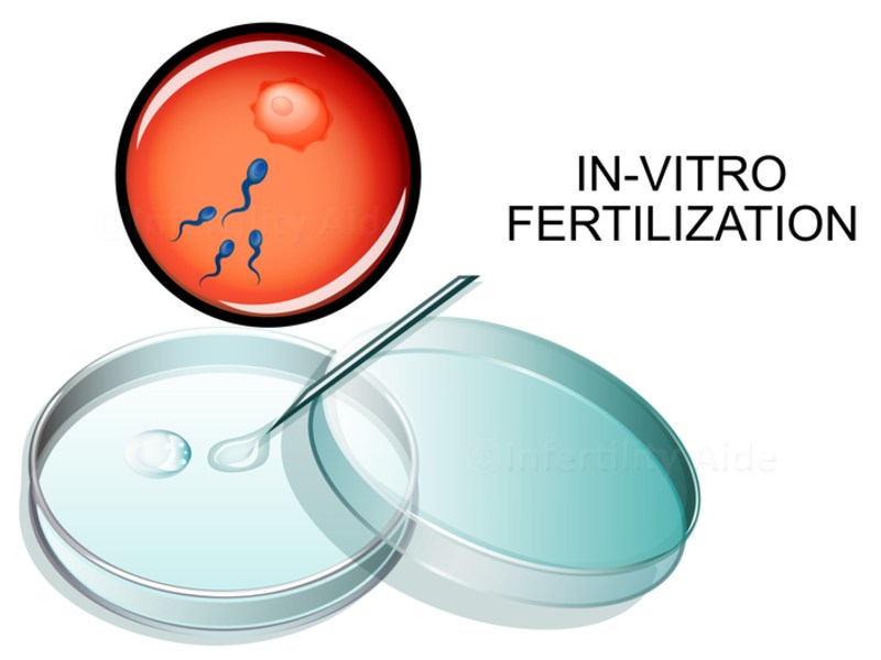 Vitro Fertilisation Ivf
