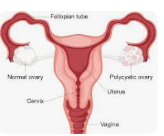 Pcos