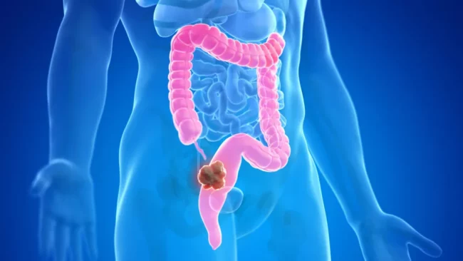 080423 Mr Colorectal Cancer Feat E1707048927682