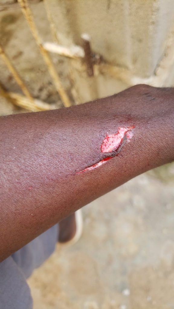 Injured20Hand