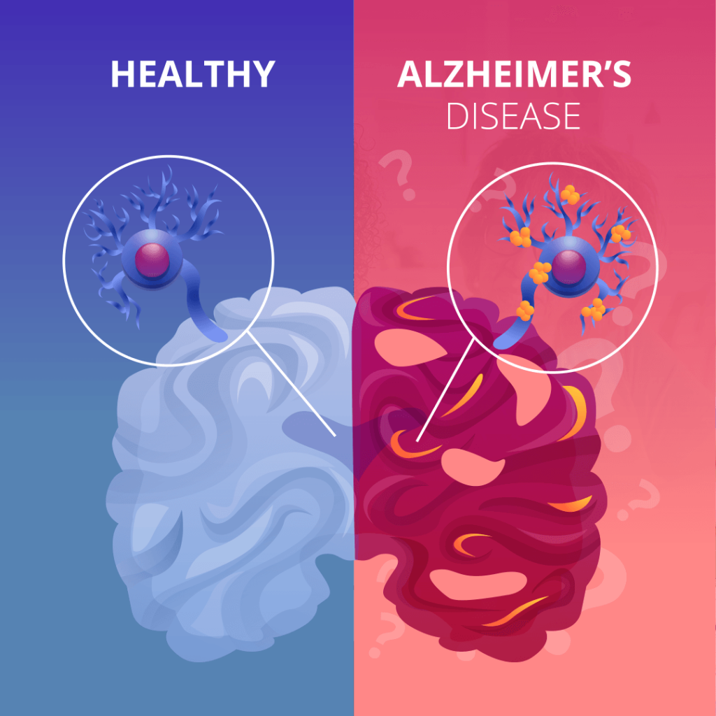 Understanding Memory Loss Alzheimers Disease The Basics.jpg