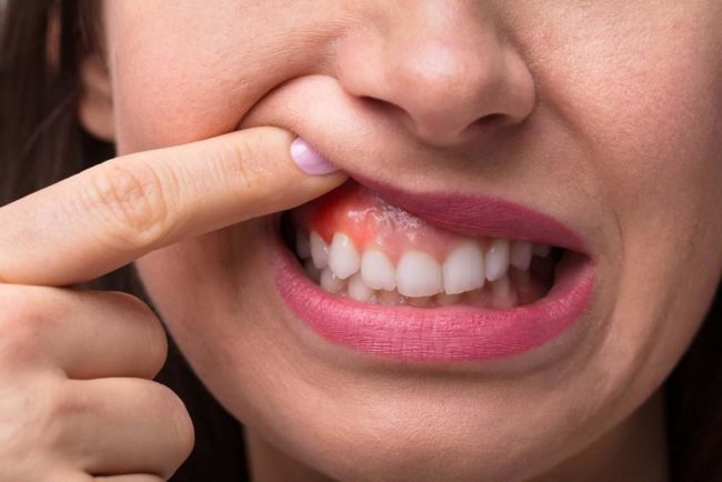 Gum Disease E1641566770481
