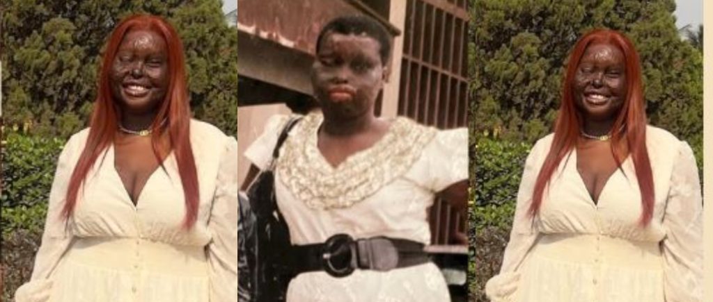 Lady Burn Surviovor Lady Burn Surviovor