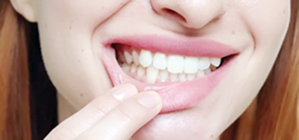 Menopause And My Teeth