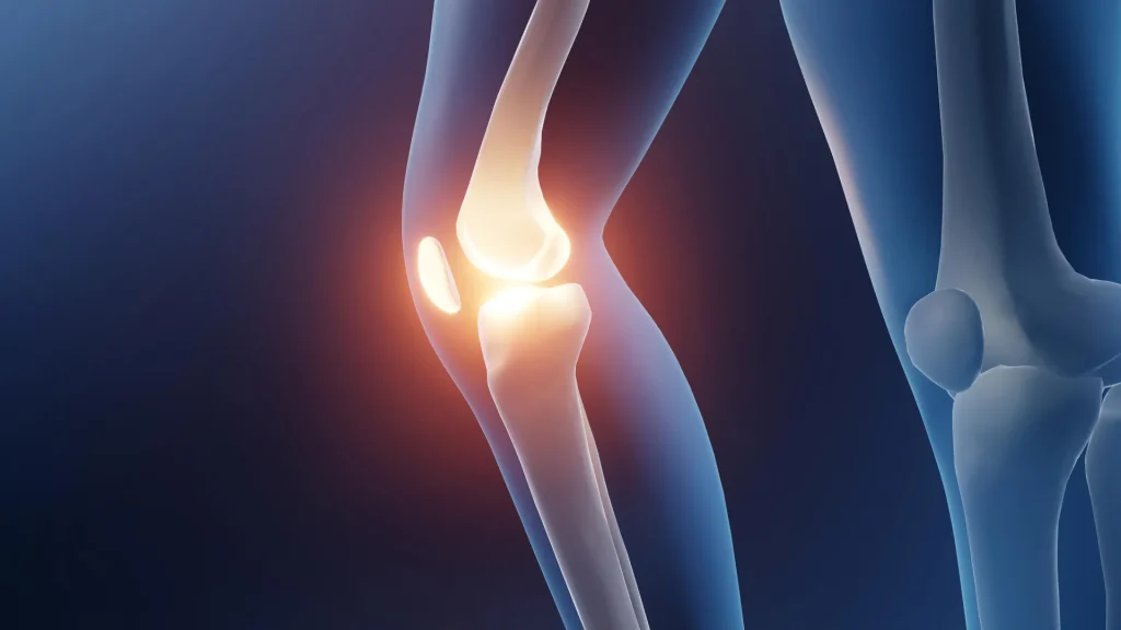 Arthritic Knee Joint Arthritis Injury Pain